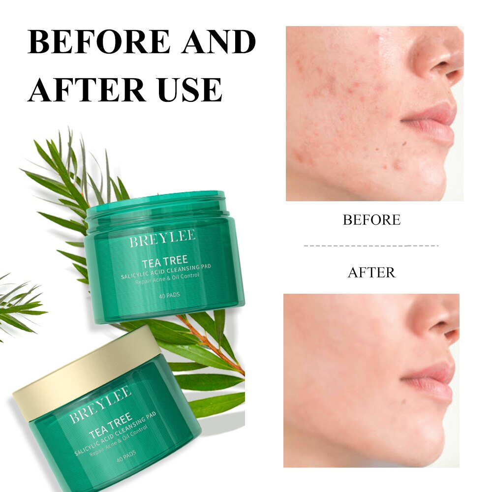 BREYLEE 2% Salicylic Acid Cotton Pads Cleaning Pores Treatment Blackhead Pimple Essence Oil Control Removal Health And Beauty
